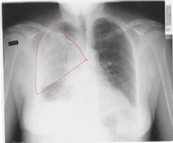 Cours - Pneumologie - Aide à la lecture d'une radiographie de thorax |  Infirmiers.com