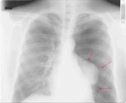Cours - Pneumologie - Aide à la lecture d'une radiographie de thorax |  Infirmiers.com